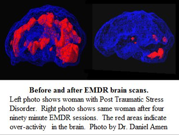 EMDR Therapy in Surrey