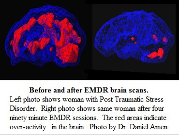 Brain scan, before and after EMDR